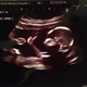 Illustration for article titled Baby Gives the Thumbs Up on Ultrasound
